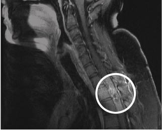 Figure 2: Thoracic MRI showing areas of hemorrhage in the spinal cord most prominent at the T2–T3 level, with multiple serpentine structures, most in keeping with a spinal cord vascular malformation such as an sAVM.