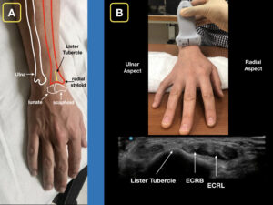 Figure 1A: The dorsal aspect of the distal forearm and radiocarpal joint. Note Lister’s tubercle and its relation to the scaphoid bone. Figure 1B: A roll is placed on the palmar aspect of the wrist for slight flexion. With the ultrasound probe in a transverse orientation, slide distally until Lister’s tubercle is visualized. The extensor carpi radialis brevis tendon (ECRB) and extensor carpi radialis longus (ECRL) can be seen on the radial aspect of Lister’s tubercle. 