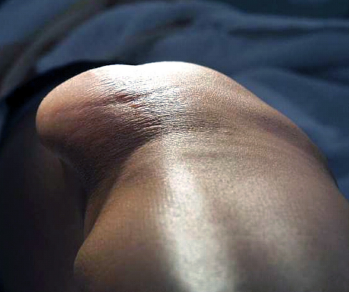 Figure 3: Visible lateral deviation of the patella.