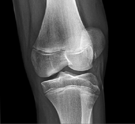 Figure 4: X-ray of avulsion fractures/loose bodies in patellar dislocation.