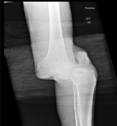 Figure 5: X-ray of dislocated femorotibial joint in a knee dislocation.