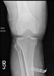 Figure 6: X-ray showing widened joint space.