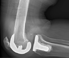 Figure 7: X-ray showing knee dislocation in a patient with a total knee arthroplasty.