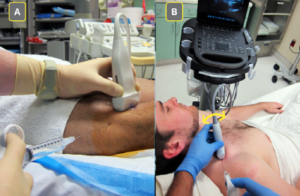 Figure 2A: For a distal sciatic nerve block in the popliteal fossa, the clinician has stabilized their nondominant hand during the block. Figure 2B: Once the needle has entered the soft tissue, gentle probe manipulation (fananing or rotating) can allow for proper needle visualization.