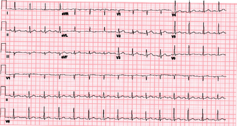 Figure 1: The patient’s initial ECG demonstrated isolated T wave inversion in aVL.