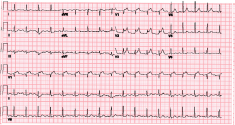 Figure 2: The patient’s repeat ECG demonstrated ST elevation in V1–V3 with reciprocal ST depression in II and aVF.