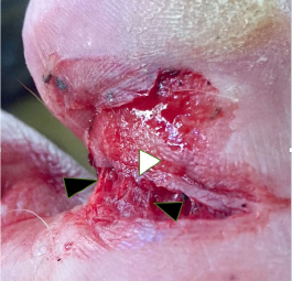 Figure 1: Wound on right great toe depictinged irregular wound edge (white arrowhead) and tissue bridging (black arrowheads).