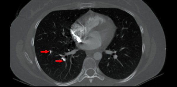 CT axial bone window