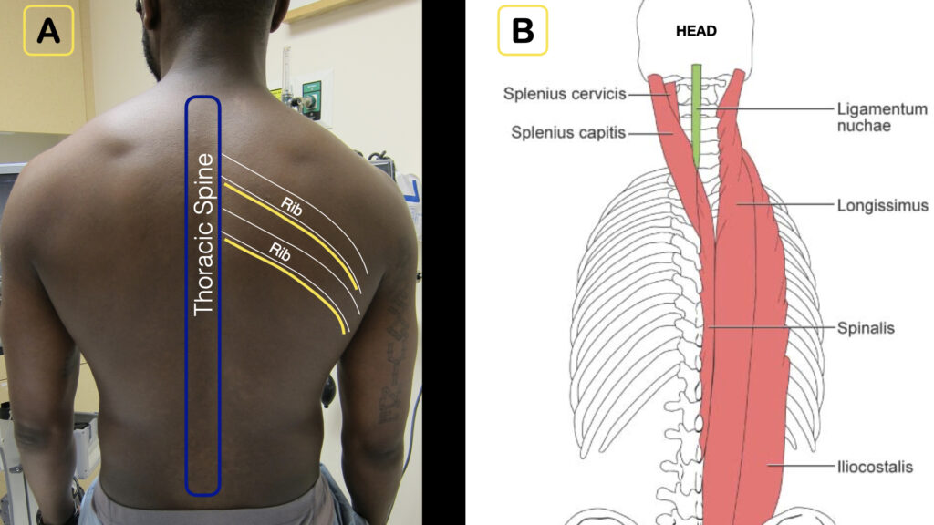 erector spinae plane block Fig1 ACEP Now