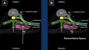 Erector spinae plane block step 2