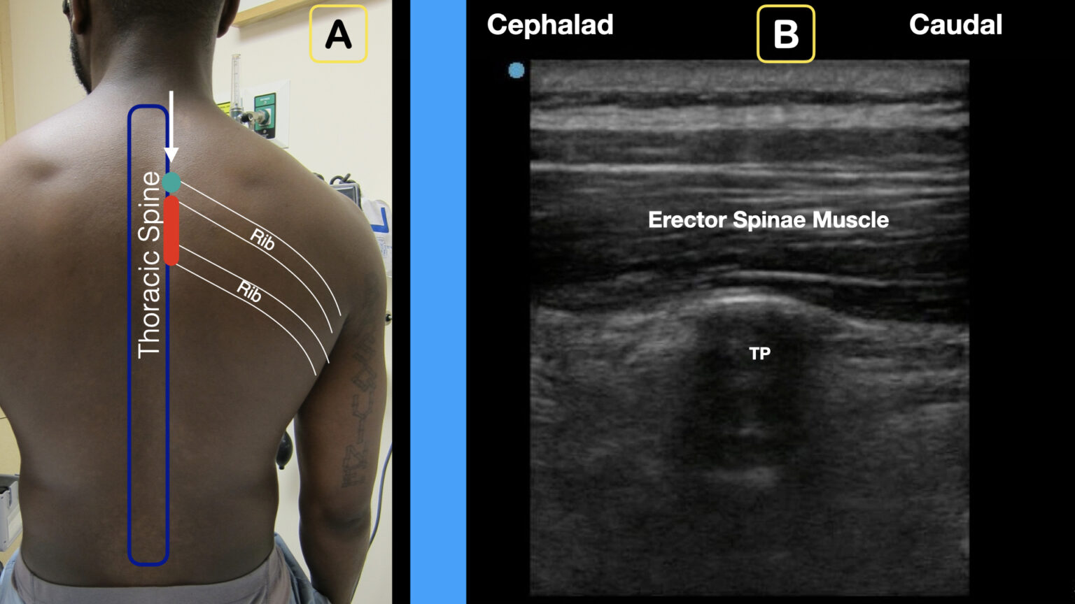 erector spinae plane block Fig5 ACEP Now