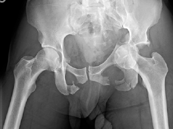 Lateral compression pelvic ring injury and left-sided T-shaped acetabulum fracture.