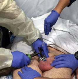 Figure 3: IV drip set irrigation is being used to dissipate heat, the patient and clinicians are shielded from sparks, and a foam aluminum splint is used to protect the skin beneath the device. (In this case, a pneumatic grinding device supplied by EMS was used.)