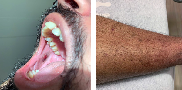 Figure 1: Clinical findings included hemorrhagic bullae in the buccal region of the patient’s mouth (left) and scattered petechiae on his lower extremities (right)