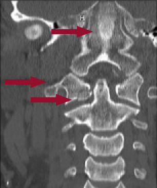 Figure 1: CT showing a C1 fracture with evidence of retroclival hemorrhage extending through foramen magnum. Facets at C1–C2 are no longer aligned.