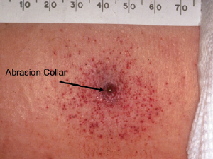 Photo 5: Intermediate-range wound with an abrasion collar and more than 100 punctate abrasions, or tattooing, from unburned pieces of gunpowder impacting the skin.