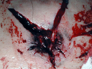 Photo 7: Contact wound with soot, seared skin, and triangular-shaped tears.