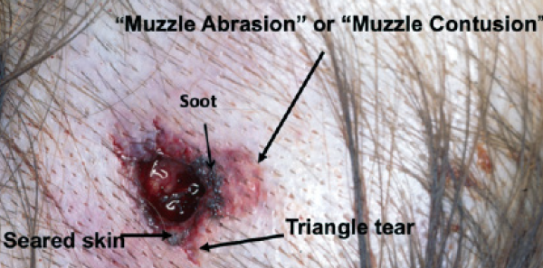 Photo 10: Contact wound with soot, seared skin, triangular-shaped tears, and a muzzle contusion from a .32-caliber pistol.