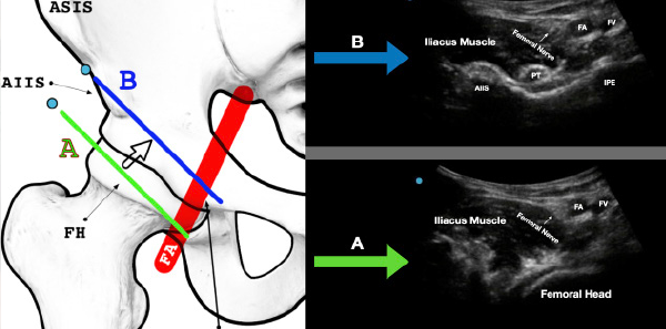 Figure 3A: The green line (A) indicates the initial location. Note the femoral artery (FA) and femoral vein (FV) as well as the femoral head. Figure 3B: Maintaining the probe parallel to the inguinal crease, slide the probe a bit cephalad. The blue line (B) indicates the ideal location for the PENG block. Note the anterior inferior iliac spine (AIIS), the iliopubic eminence (IPE), and the psoas tendon (PT). The femoral vasculature (FA/FV) and femoral nerve in the proximal aspect of the ultrasound screen will often be visible at this location.