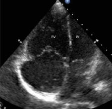 Figure 1: Four-chamber apical view demonstrating enlarged right ventricle (RV). 