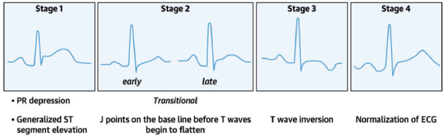 pericarditis