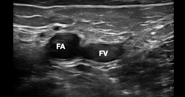 eFAST 2.0: Refining an Integral Trauma Exam - ACEP Now