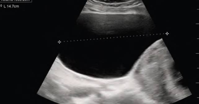 Case Report: Acute Urinary Retention in a Pregnant Woman - ACEP Now
